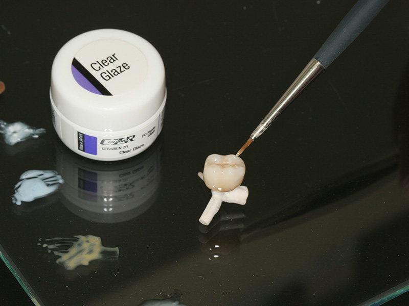 Implantatkrone CEREC Methode